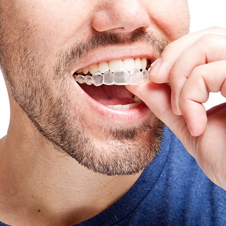 What to expect with Invisalign treatment