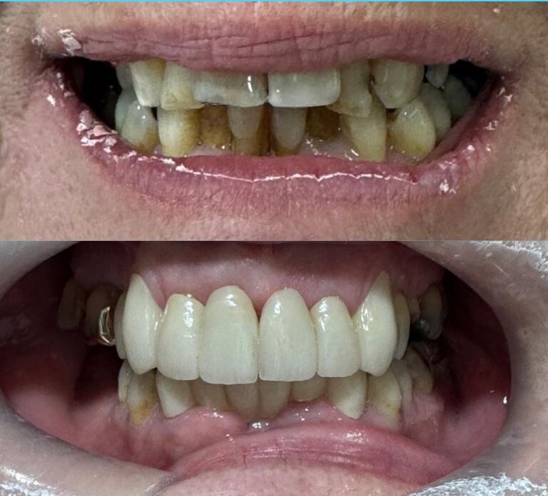 Multiple Teeth Dental Implant