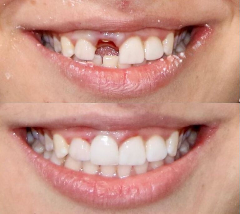 Single Tooth Dental Implant