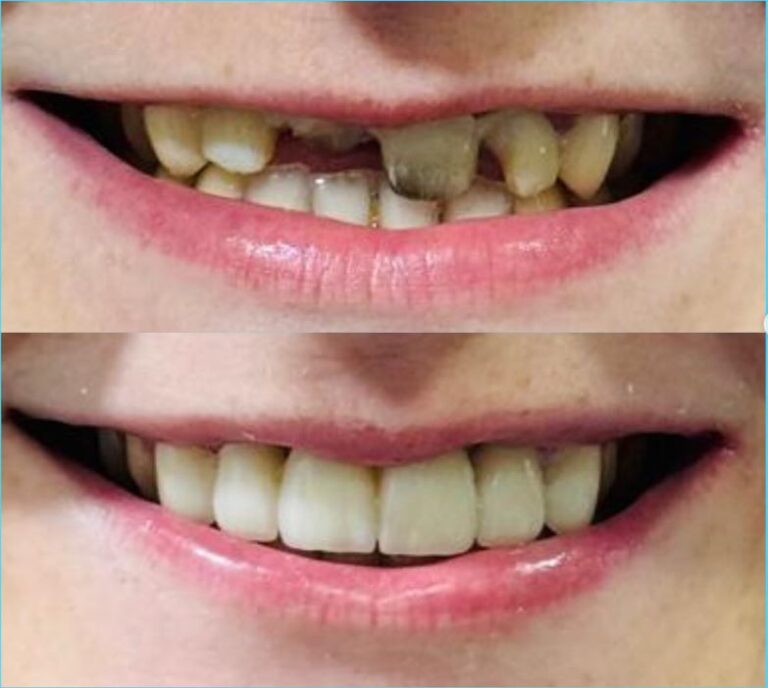 Smile Reconstruction