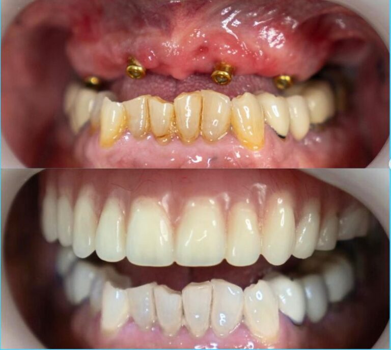 Upper Jaw Dental Implant